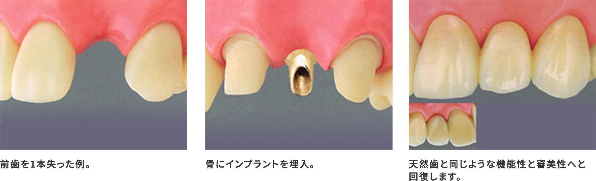 インプラントによる歯科治療のイメージ