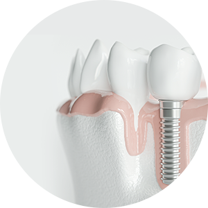 インプラントによる歯科治療