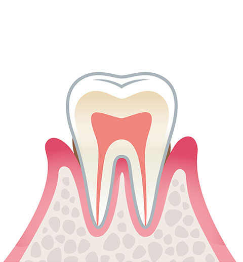 歯周炎（軽度）