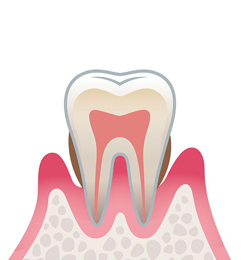 歯周炎（中度）