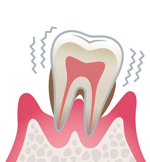 歯周炎（重度）