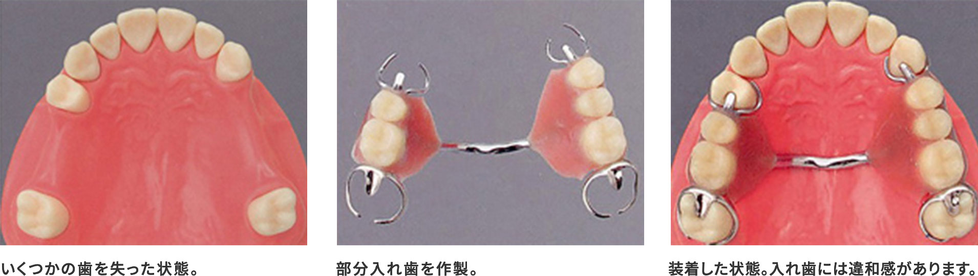 入れ歯による治療との違い