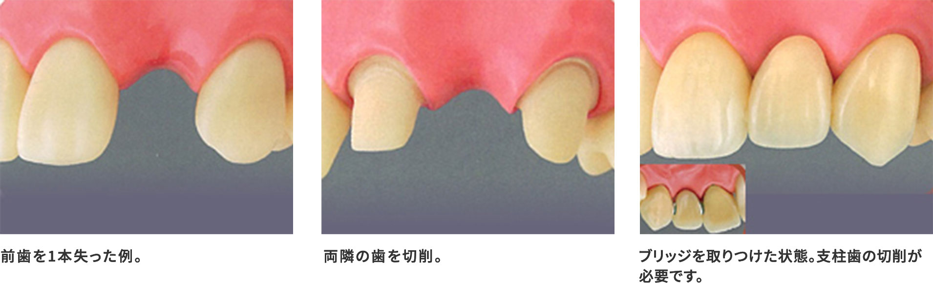 ブリッジによる治療との違い